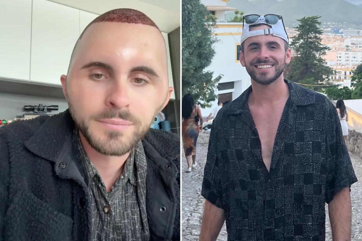 Why Alex Finken's Hair Transplant Left Him Looking Like a Cartoon